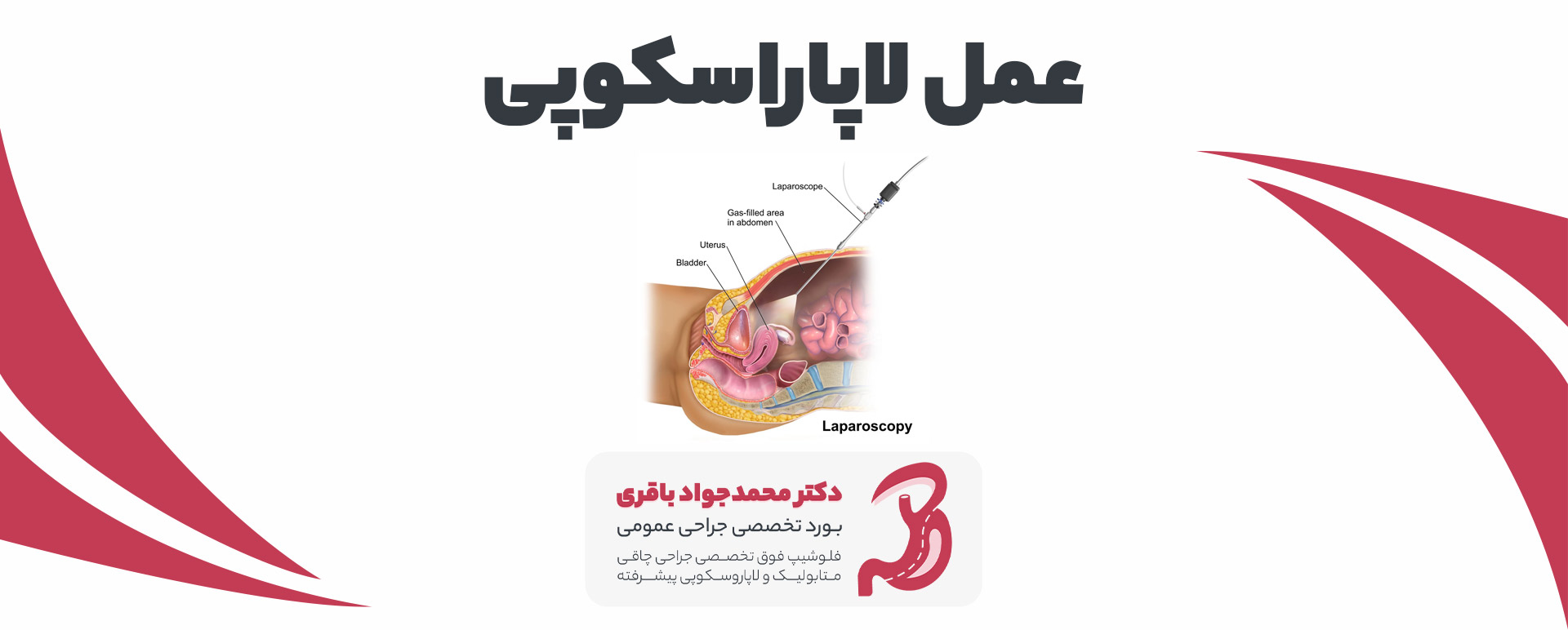 Laparoscopic surgery pc