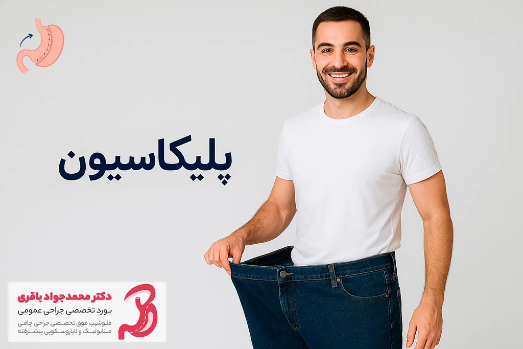 جراحی پلیکاسیون معده