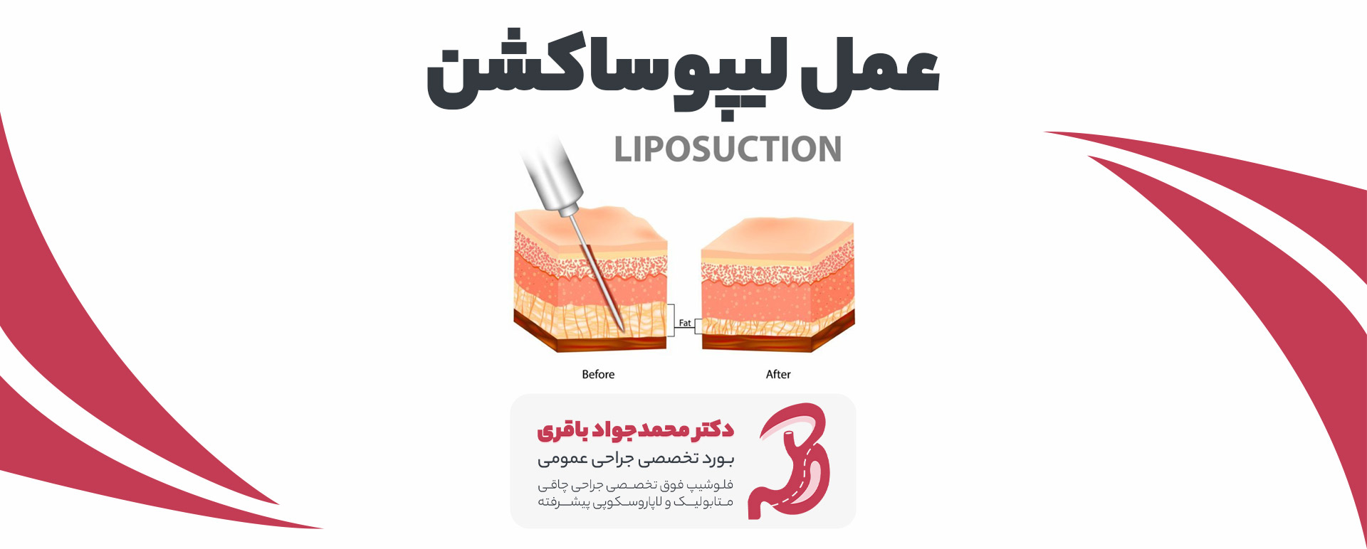 Liposuction pc