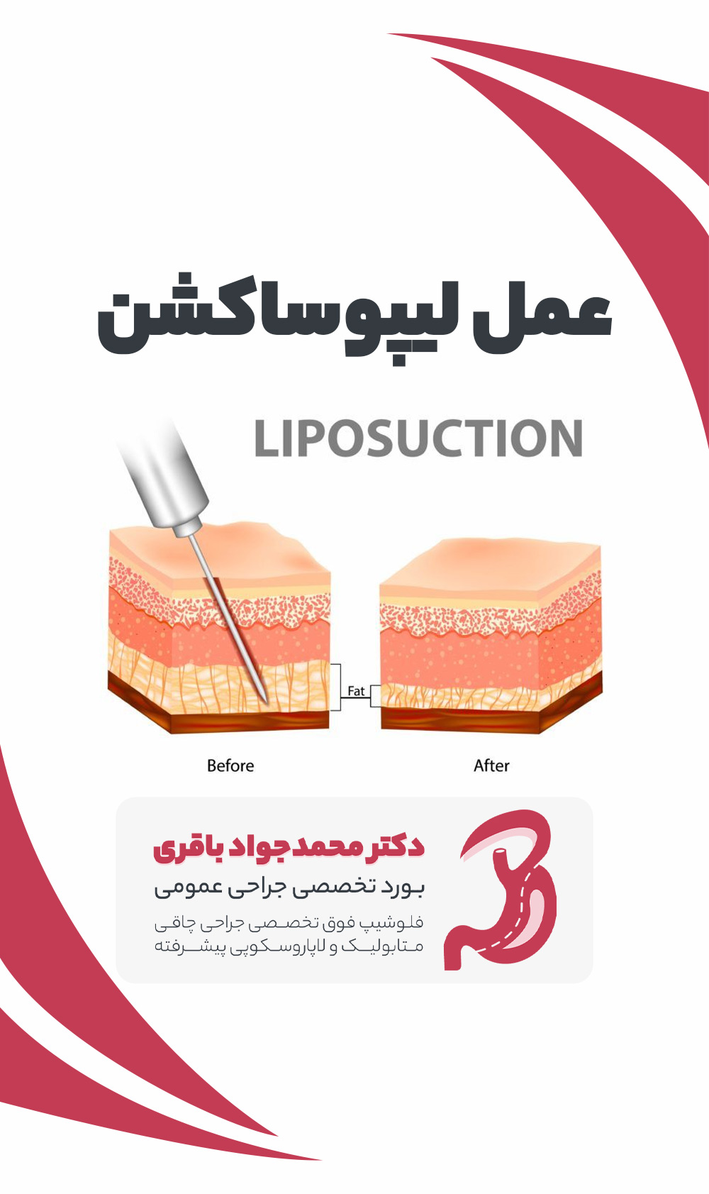 Liposuction phone