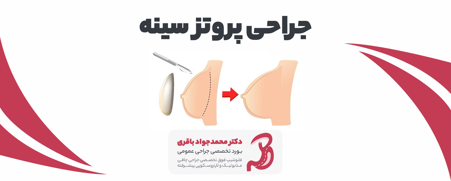هزینه پروتز سینه