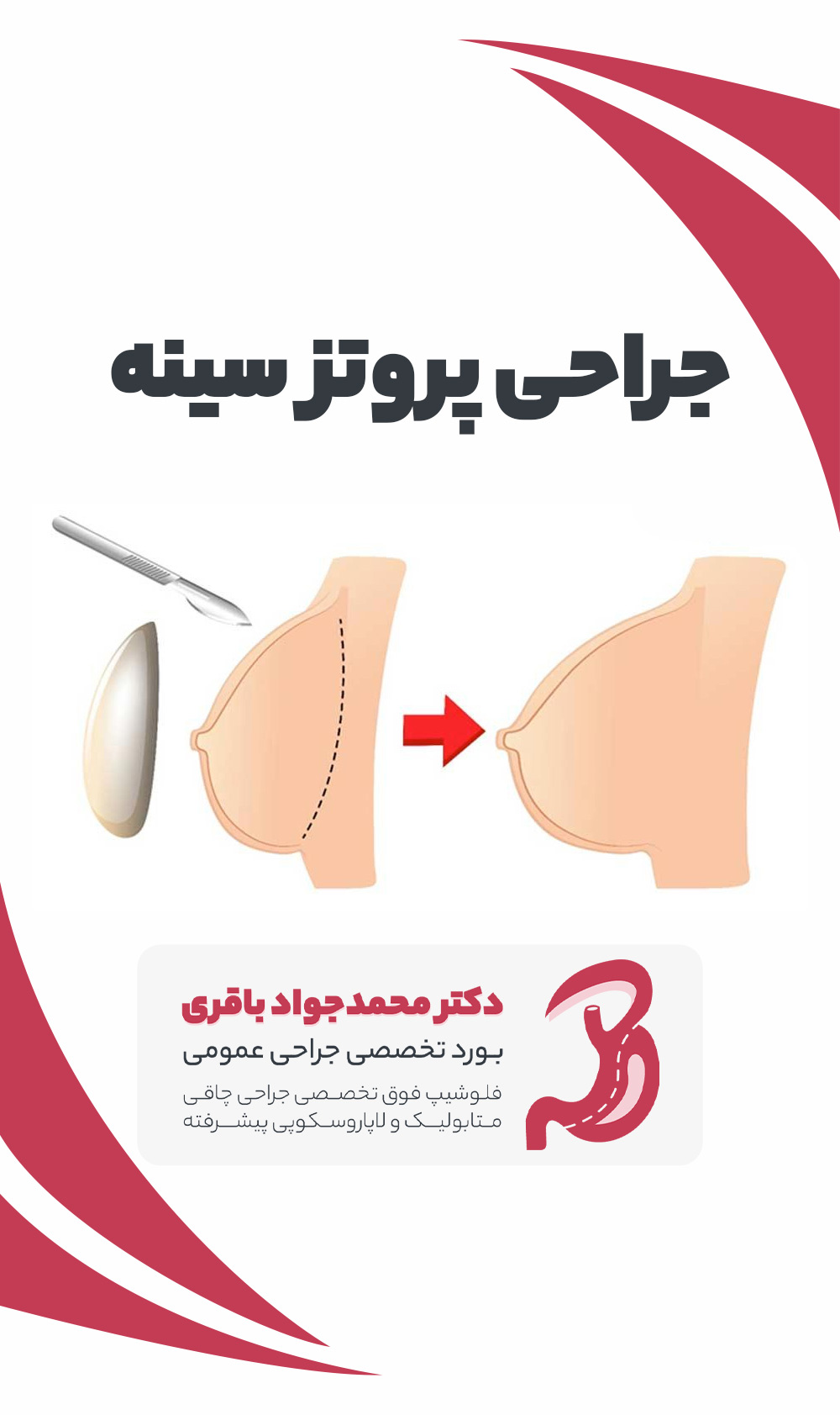 Breast prosthesis phone