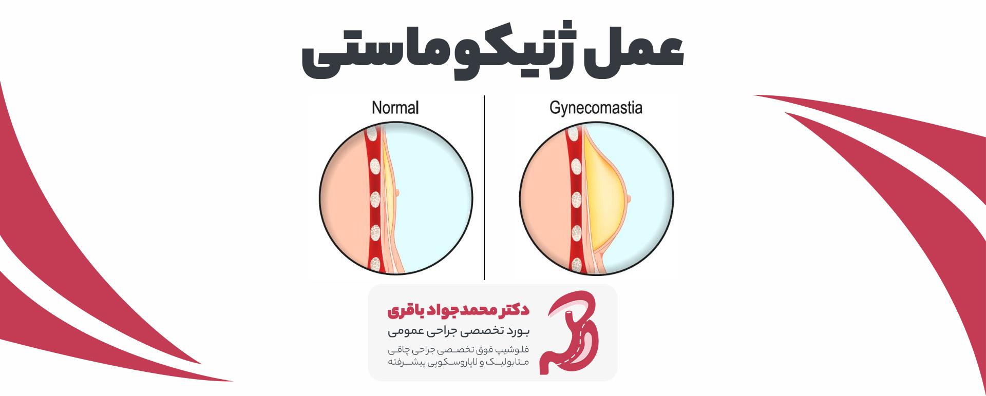 Gynecomastia pc