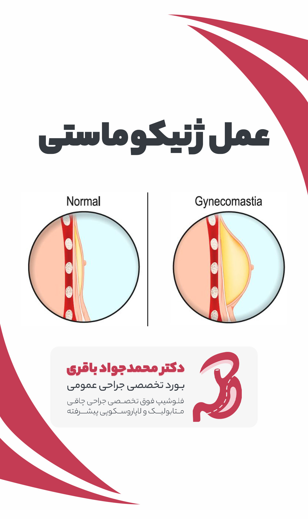Gynecomastia phone