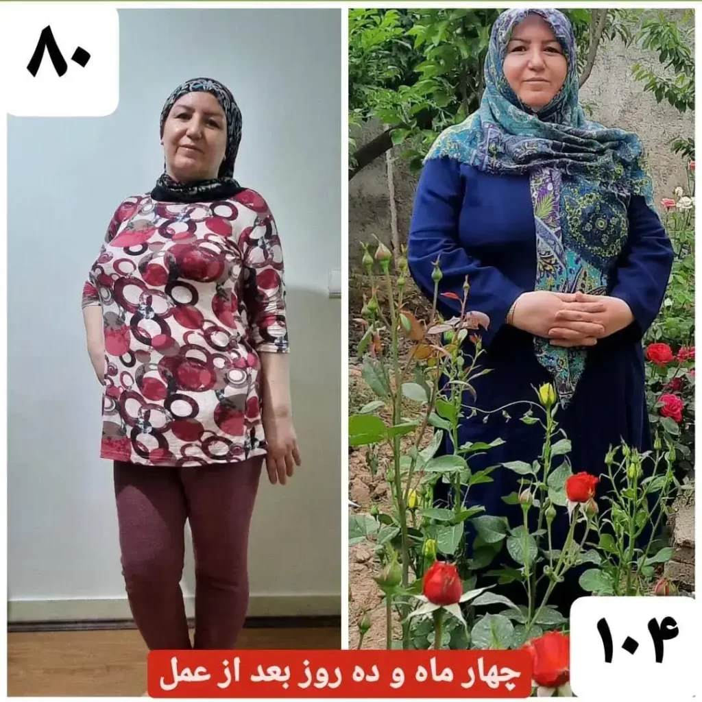 عکس قبل و بعد عمل اسلیو معده