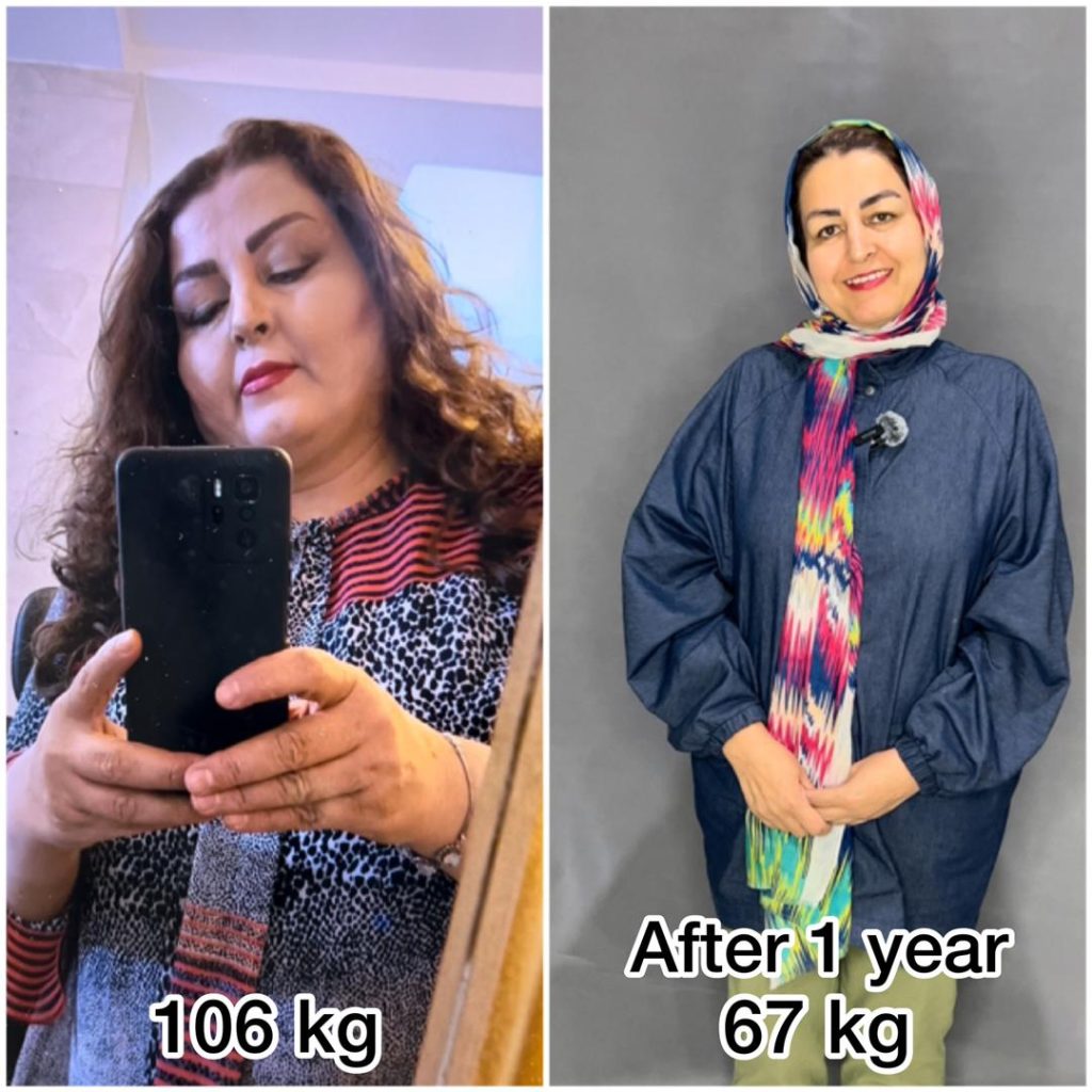 اسلیو معده قبل و بعد