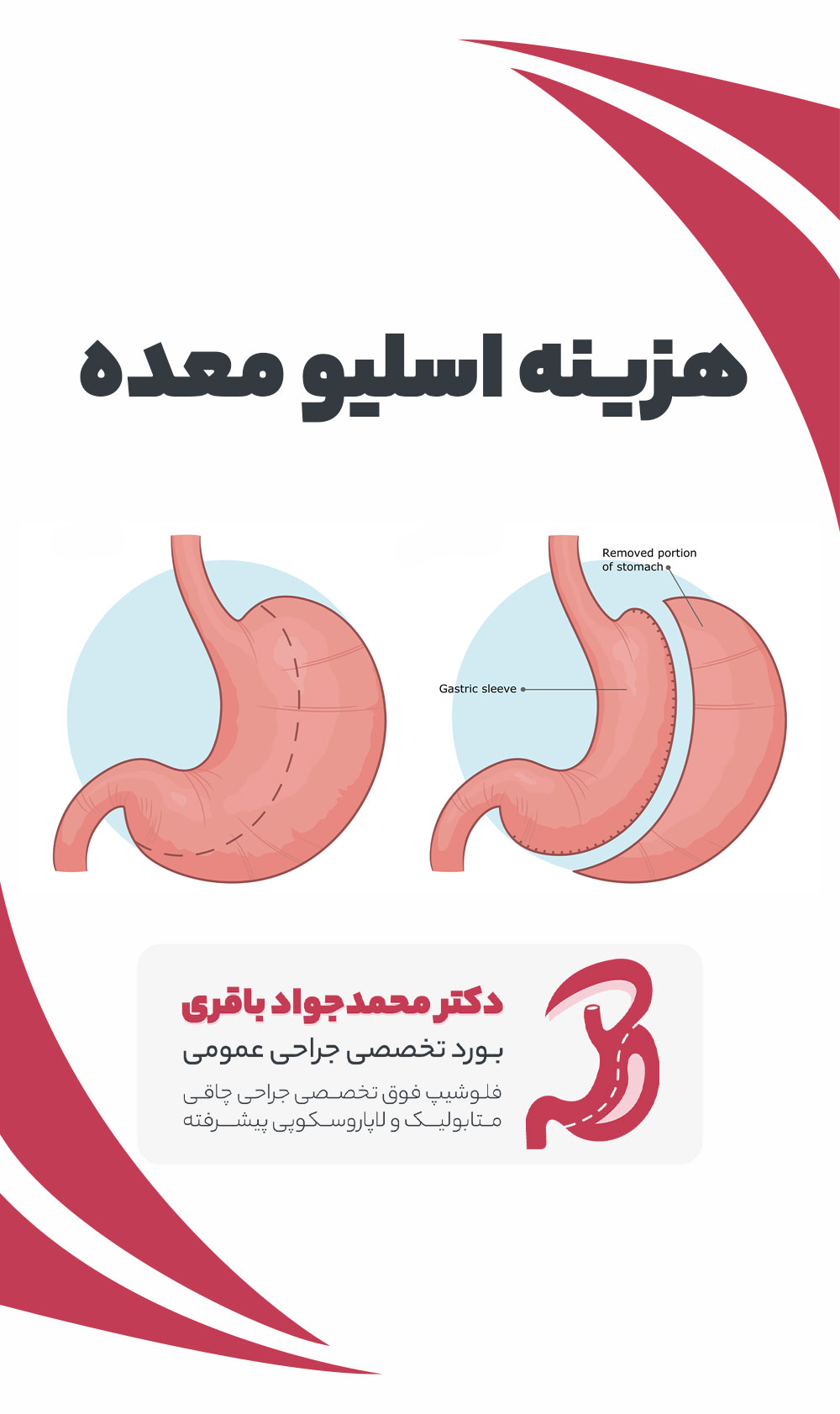 Gastric sleeve price mobile