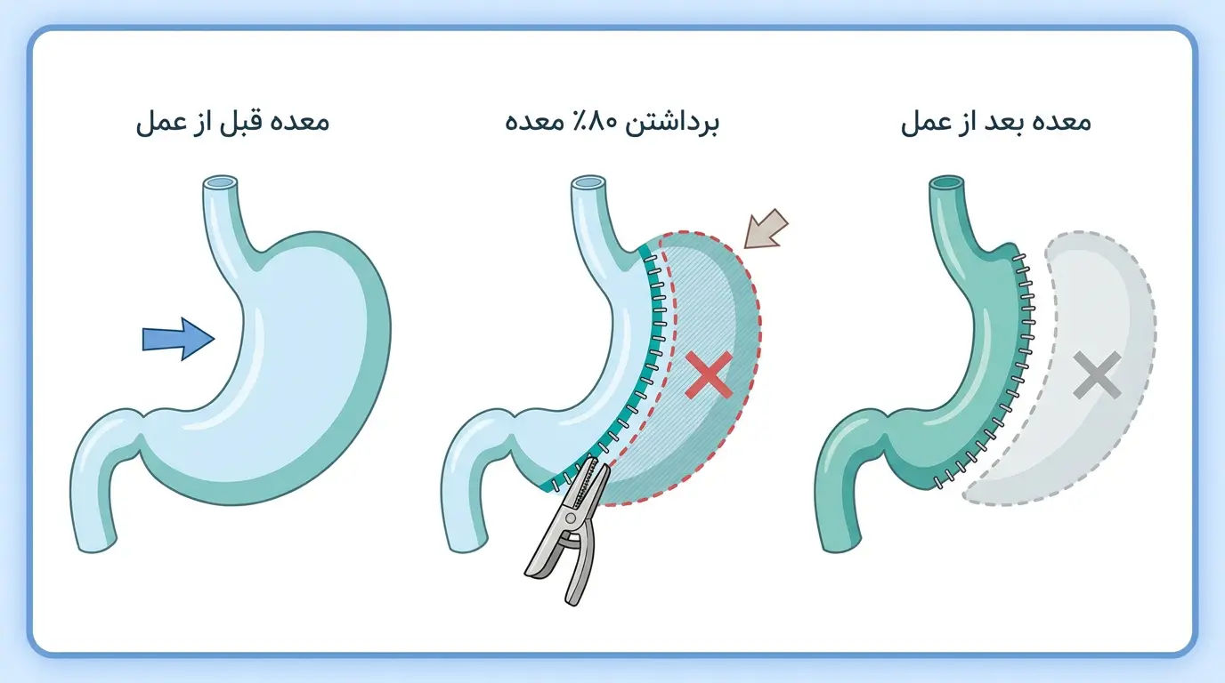 اینفوگرافیک مراحل عمل اسلیو معده به روش لاپاراسکوپی