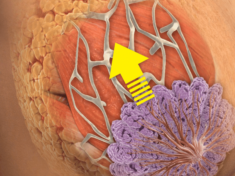 ژنیکوماستی، لیفت سینه و پروتز سینه در خانم ها؛ راهکارهای جراحی موثر 2 لیفت سینه در خانم ها