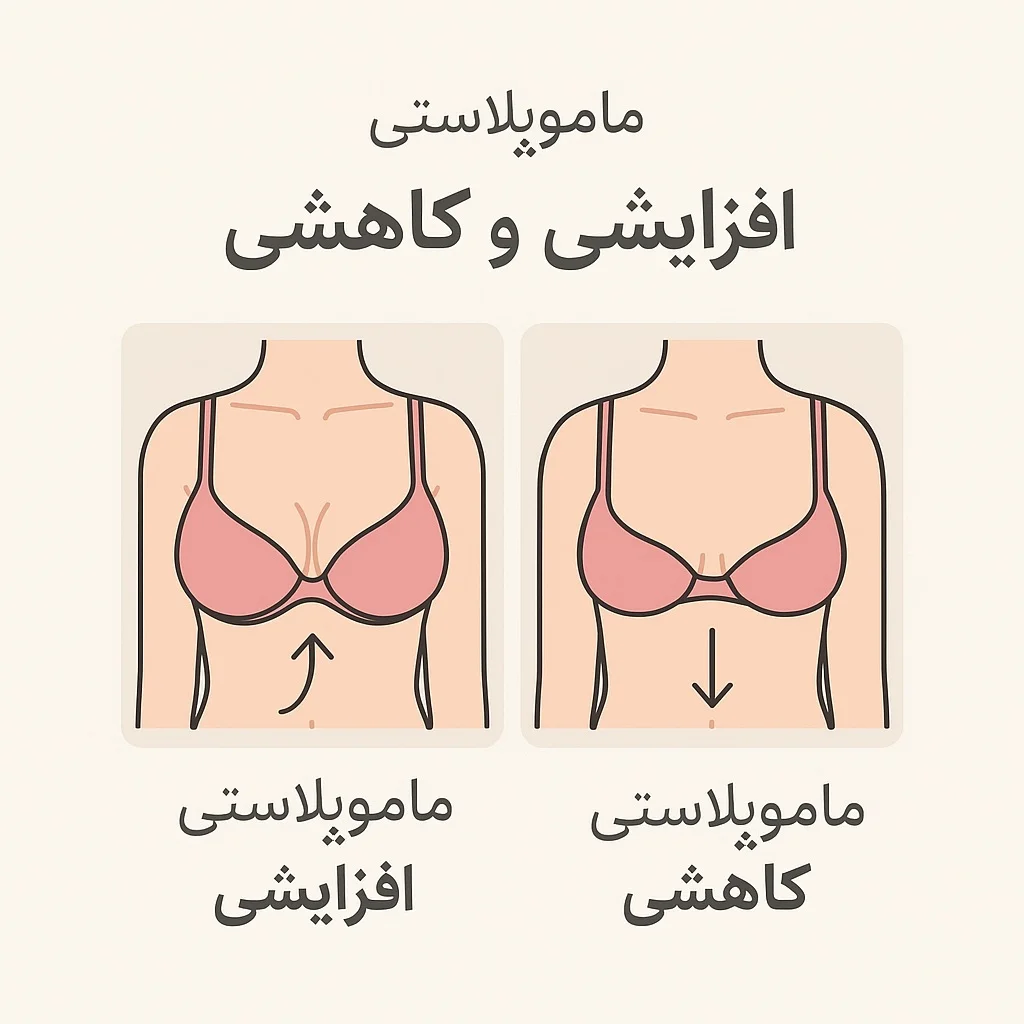 تفاوت ماموپلاستی افزایشی و کاهشی 1 تفاوت ماموپلاستی افزایشی و کاهشی