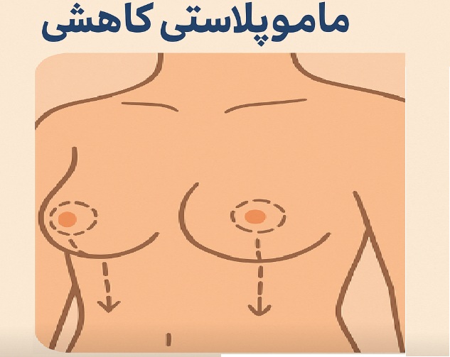 ماموپلاستی کاهشی 1 ماموپلاستی کاهشی