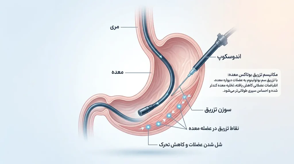  نحوه تزریق بوتاکس معده از طریق آندوسکوپی - اینفوگرافیک فارسی